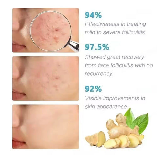 Crème Anti-Acné Purifiante – Soin Anti-Imperfections
